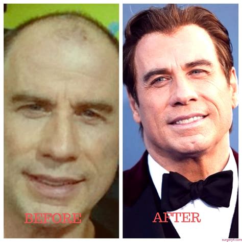 john travolta face lift|Decoding John Travolta’s Plastic Surgery Transformation Rumors